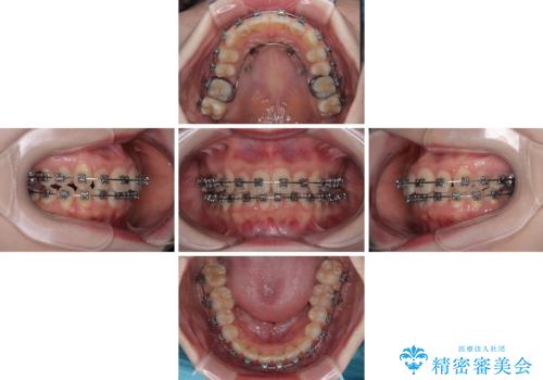 飛び出した前歯を引っ込める ワイヤー装置の非抜歯矯正の治療中