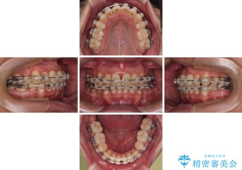矯正治療途中で転院　遠方への転勤で通院困難な方の矯正治療の治療中