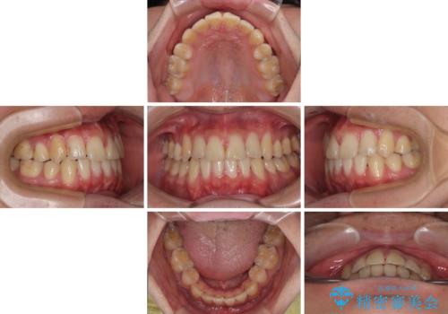 矯正治療の後戻り インビザライン・モデレートパッケージで短期間治療の治療中