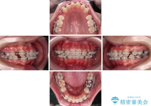 口ゴボが気になる 上下4本の抜歯矯正の治療中
