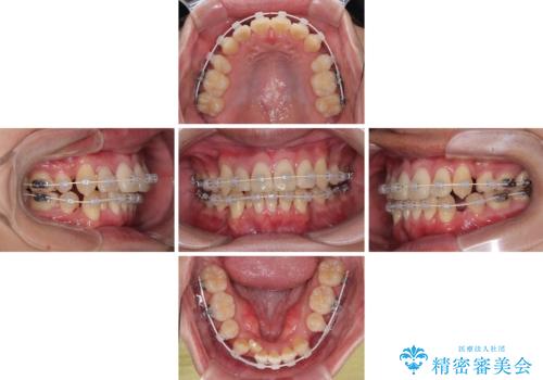 八重歯と重なった前歯　目立たない装置での抜歯矯正の治療中