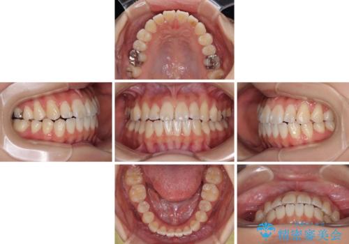 舌の突出癖が原因 インビザライン矯正による開咬改善の治療中