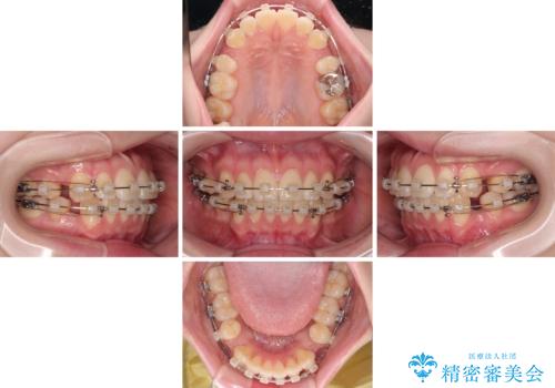 飛び出した前歯を引っ込める　ワイヤー装置での抜歯矯正治療の治療中