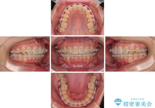 インビザラインの自己管理は煩わしい　ワイヤー矯正で短期間矯正治療の治療中