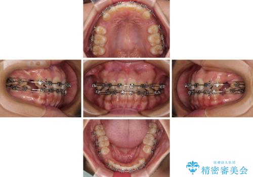 デコボコと捻れて前に飛び出した歯列 抜歯矯正でスッキリした口元にの治療中