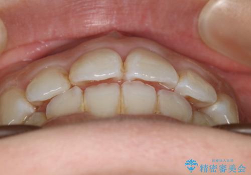 出っ歯が気になる 抜歯+ワイヤー矯正治療の治療後