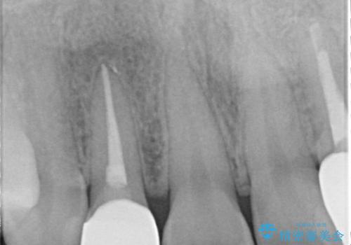 歯に食べ物がはさまる　色も揃えたい　オールセラミックで治療の治療後