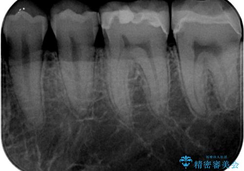 銀歯を白くしたい　セラミックインレー修復の治療後