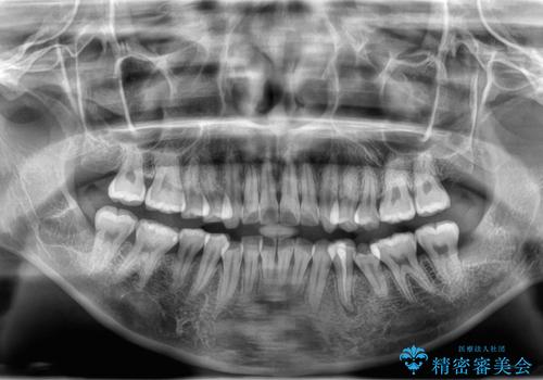 親知らず抜歯の治療後