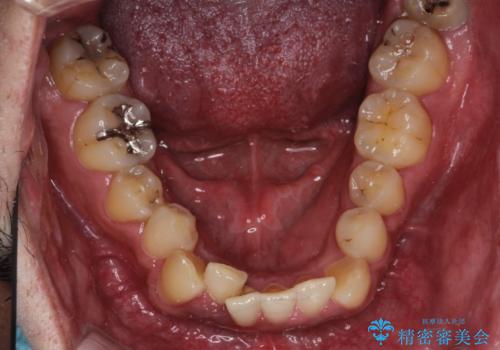 【ワイヤー矯正】かみ合わせを治したいの治療前