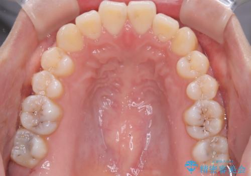 【ワイヤー矯正】前歯の突出感、下の歯の並びを良くしたいの治療前