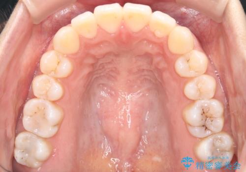 【ワイヤー矯正】前歯の突出感、下の歯の並びを良くしたいの治療後