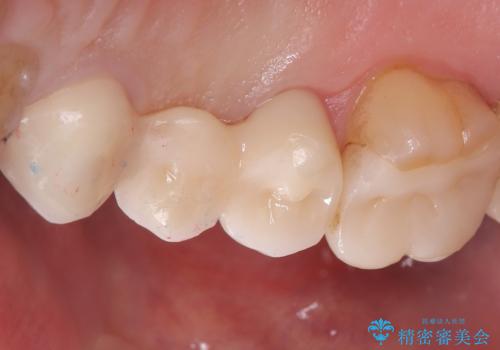 【セラミッククラウン】歯が欠けた!の治療後