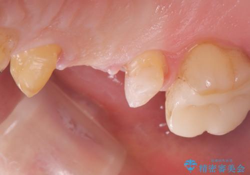 【セラミッククラウン】歯が欠けた!の治療中