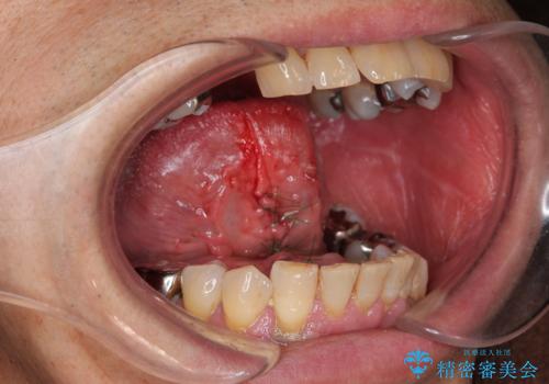 『舌小帯形成術』 ベロの動きを良くして滑舌を改善したいの治療中