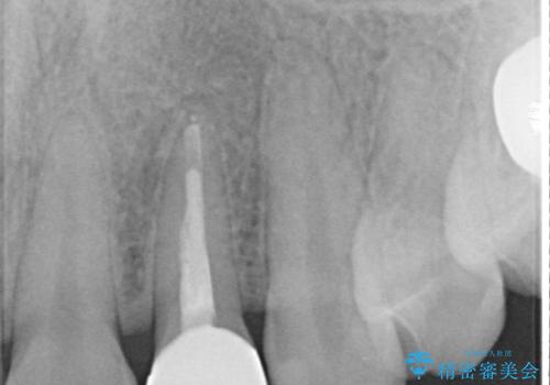 歯に食べ物がはさまる　色も揃えたい　オールセラミックで治療の治療後