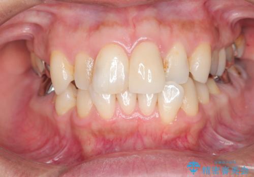 転んで折れた前歯セラミック治療で審美改善の治療後