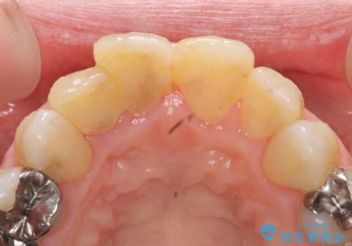 [ ジルコニアセラミッククラウン] 神経の死んだ前歯の治療の治療前