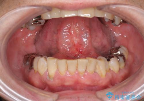 『舌小帯形成術』 ベロの動きを良くして滑舌を改善したいの治療後