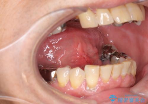 『舌小帯形成術』 ベロの動きを良くして滑舌を改善したいの治療後