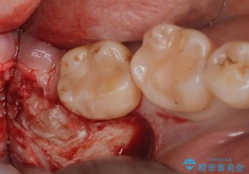 親知らず抜きたい。の治療中