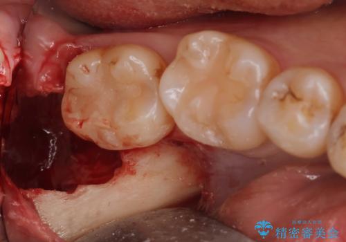 親知らず抜きたい。の治療後