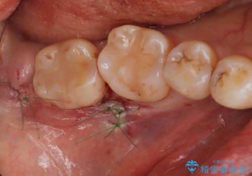 親知らず抜きたい。の治療後