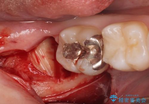 親知らずを抜きたいの治療中