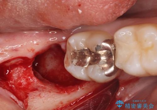 親知らずを抜きたいの治療中