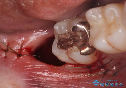 親知らずを抜きたいの治療後