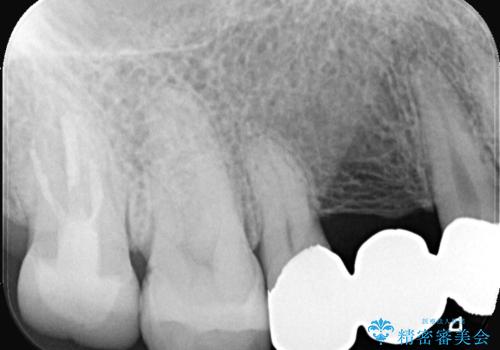 【セラミッククラウン】歯が欠けた!の治療前