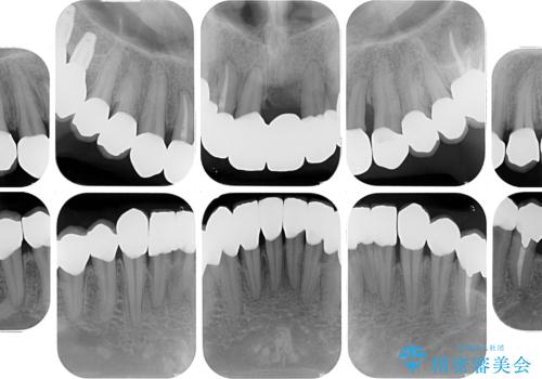 かかりつけ医の治療方針に疑問 歯周病治療と矯正治療を合わせた総合歯科治療の治療後