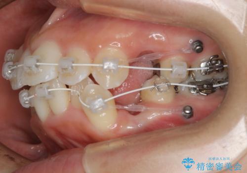 出っ歯が気になる　抜歯+ワイヤー矯正治療の治療中