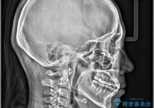 「歯を抜かずに、たった10ヵ月。」目立ちにくい大人の矯正の治療後