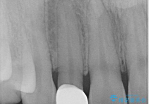 矯正後、矮小歯をオールセラミッククラウンで審美修復の治療後