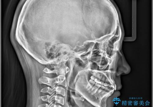 「歯を抜かずに、たった10ヵ月。」目立ちにくい大人の矯正の治療前