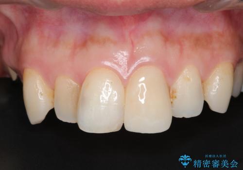 転んで折れた前歯セラミック治療で審美改善