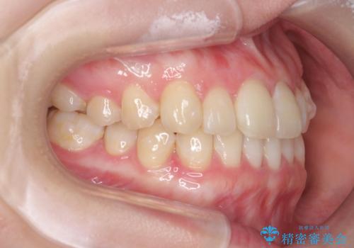 [ インビザラインライト ]  短期間で行う前歯のマウスピース治療の治療中