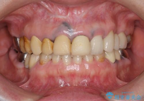 保険適応 硬質レジン前装冠から審美的でオールセラミッククラウンへの治療前