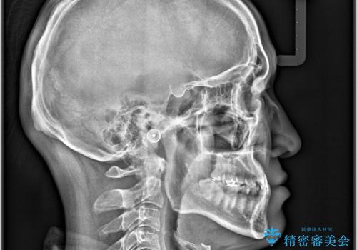 【ワイヤー矯正】かみ合わせを治したいの治療前