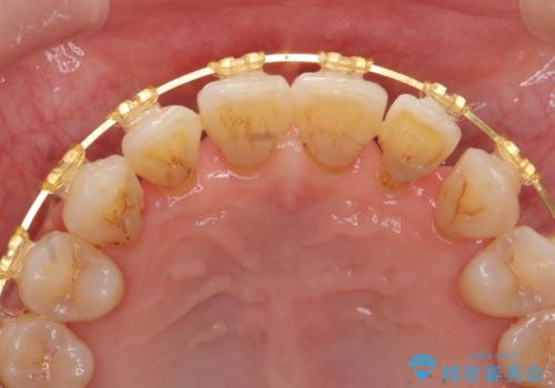 [ 全て歯を抜かなければいけないと言われた] 矯正治療を含む包括的歯周病治療の治療後