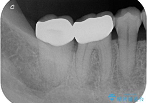 欠けやすい大きなプラスチック充填から、耐久性の高いセラミッククラウンへの治療後
