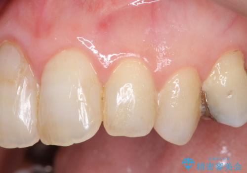 [ ジルコニアセラミッククラウン] 神経の死んだ前歯の治療の症例 治療前