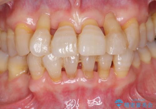 [ 全て歯を抜かなければいけないと言われた] 矯正治療を含む包括的歯周病治療の治療前