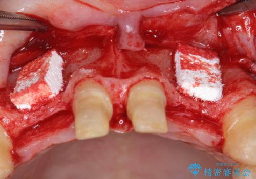 [ 全て歯を抜かなければいけないと言われた] 矯正治療を含む包括的歯周病治療の治療前