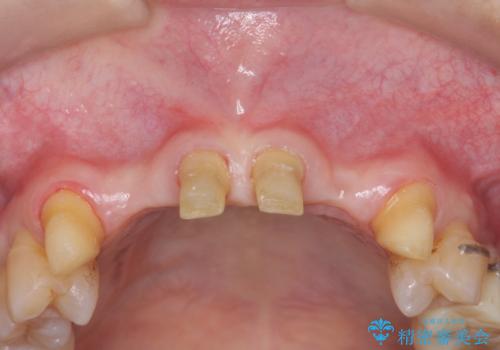 [ 全て歯を抜かなければいけないと言われた] 矯正治療を含む包括的歯周病治療の治療前