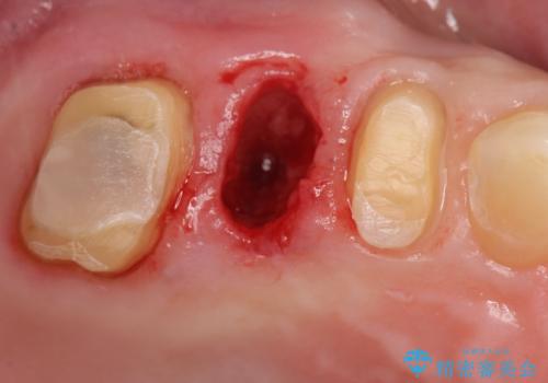 過大な力で折れた失活歯 セラミックブリッジ治療の治療中