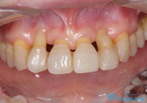 [ 全て歯を抜かなければいけないと言われた] 矯正治療を含む包括的歯周病治療の治療前