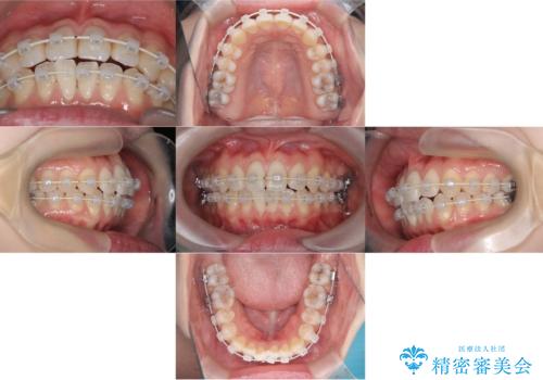 【ワイヤー矯正】前歯の突出感、下の歯の並びを良くしたいの治療中