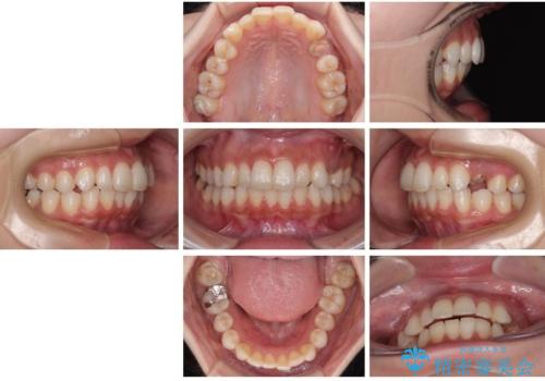 根元から折れてしまった歯をどうする?矯正かインプラントかを比較検討した症例の治療前